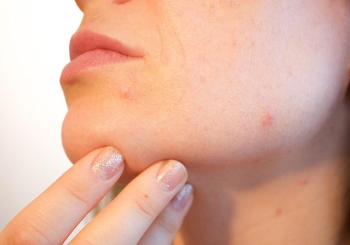 Acne em mulheres adultas pode causar impactos na autoestima