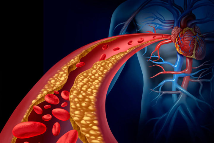 Altas taxas de colesterol podem ocasionar infarto do coração e AVC; veja como se prevenir